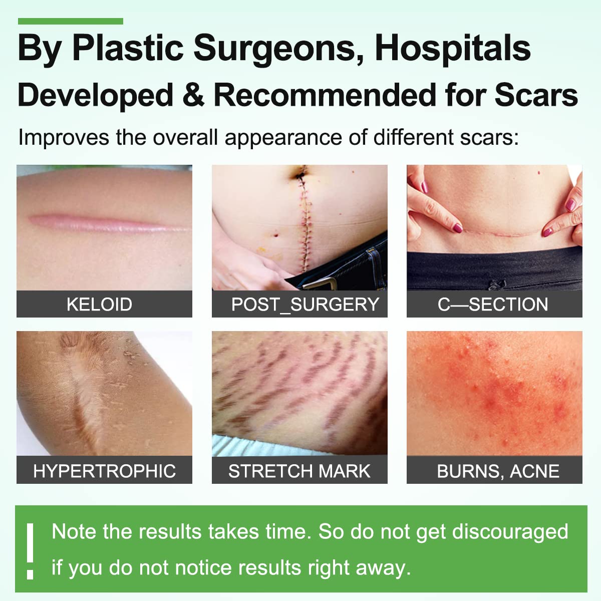 ZODENIS silicone scar tape on a surgical scar provides discreet coverage.