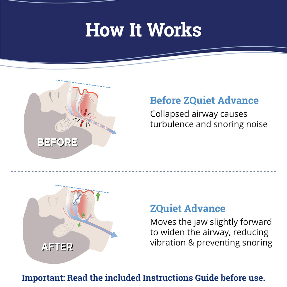 ZQuiet Advance mold trays for upper and lower teeth enable precise personalization