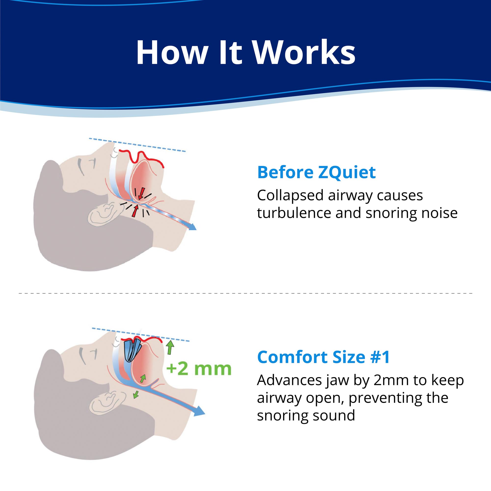 ZQuiet mouthpiece close-up blue shows smooth BPA-free material.