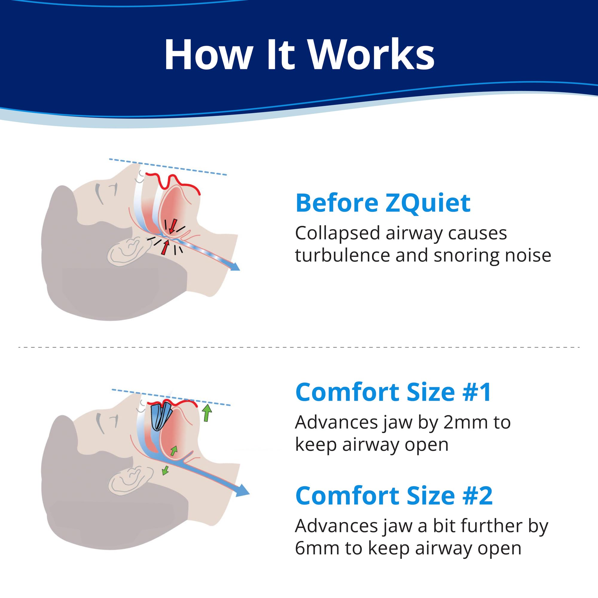 ZQuiet Size 2 mouthpiece with +6mm jaw adjustment for enhanced fit.