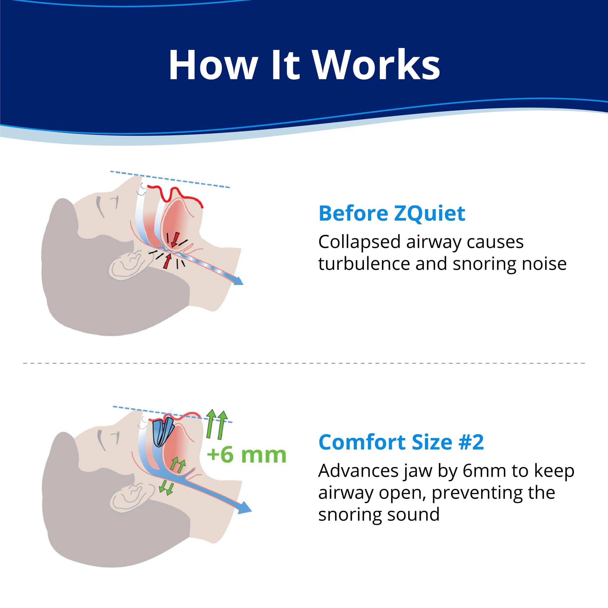 ZQuiet open-front living-hinge design allows natural jaw movement and sipping water