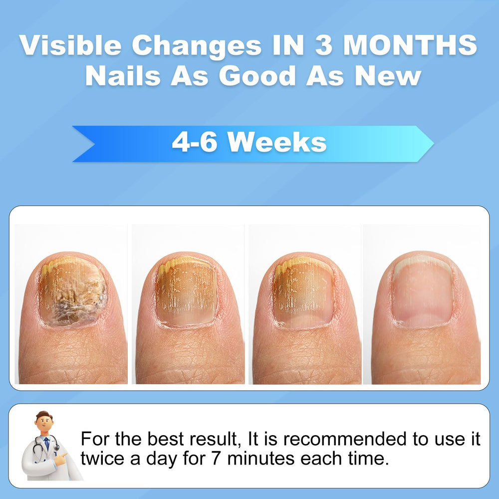 ZZP home-use laser device for onychomycosis supports simple nail care.