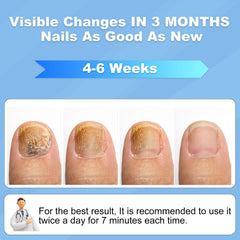 ZZP home-use laser device for onychomycosis supports simple nail care.
