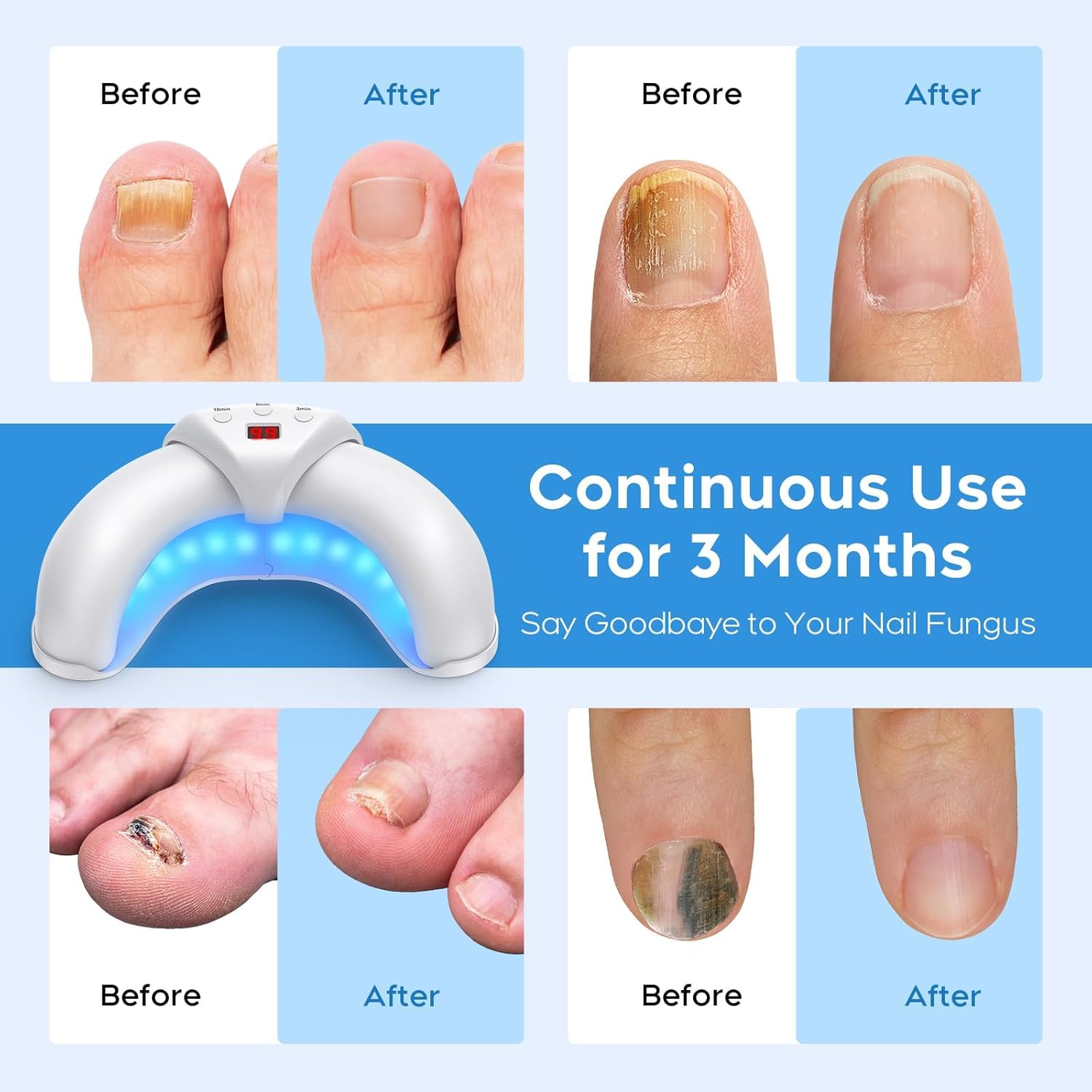 ZZP nail fungus device at home, compact and portable for travel.